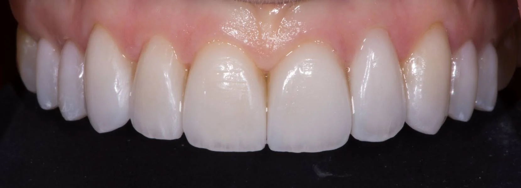 FOA feldspathic veneers 2.JPG