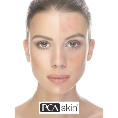 hydroquinone.jpg