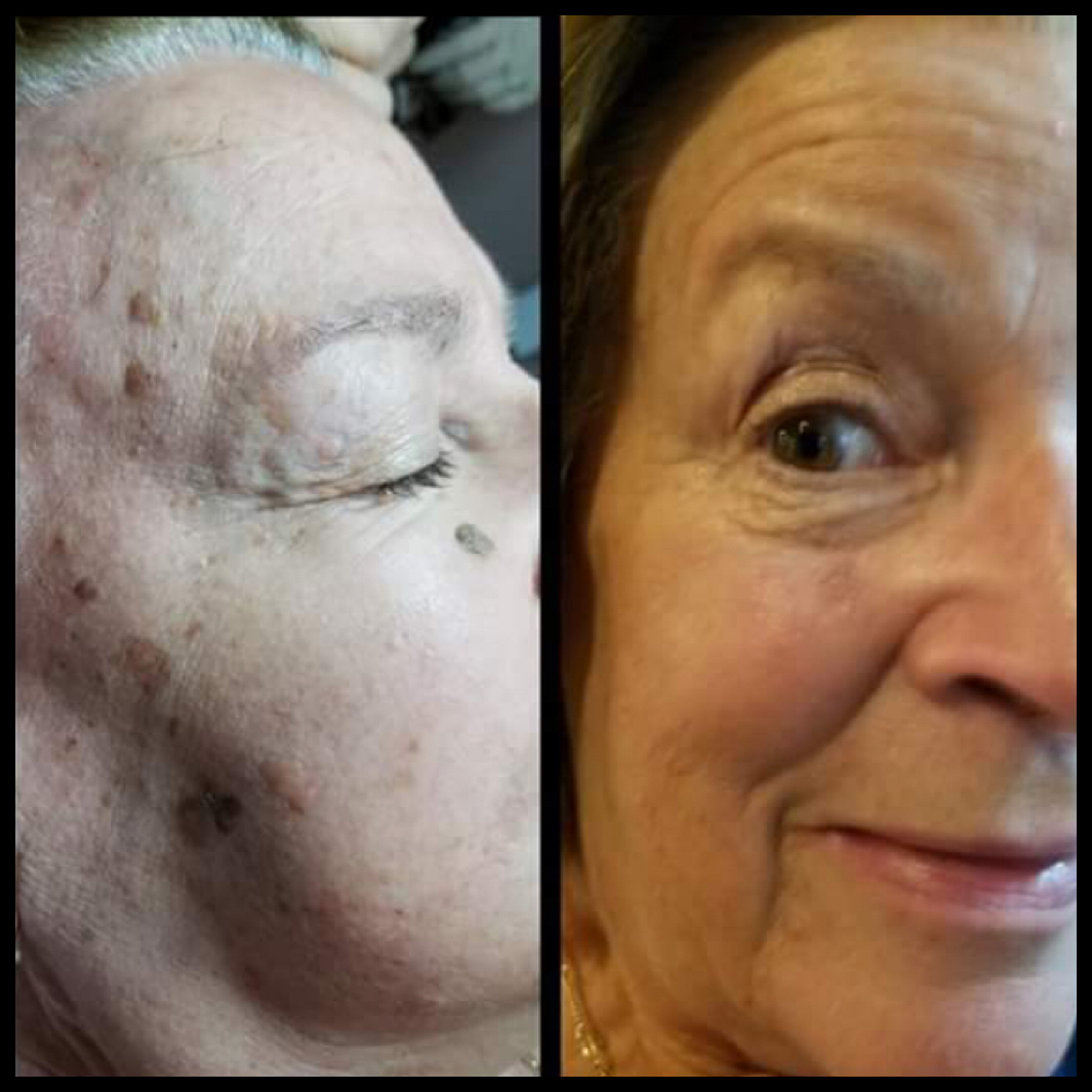 Seborrheic Keratosis — Sharon Gordon Skin