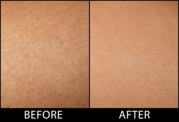 Keratosis-Pilaris-Before-After-Shot-500x344.jpg