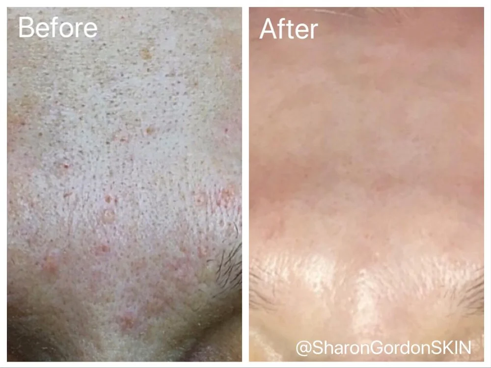 Sebaceous Hyperplasia Before And After