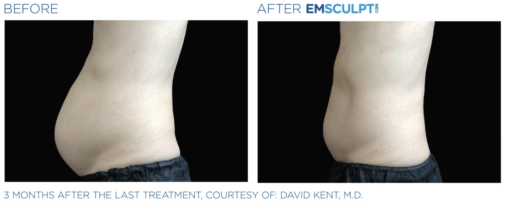 emsculpt-neo-before-after-1-2048x829.png