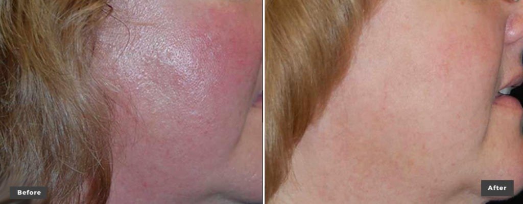 Skin-Revitalization-Resurfacing-Treated-with-xeoLaser-Genesis-before-after-pictures-1024x401.jpg