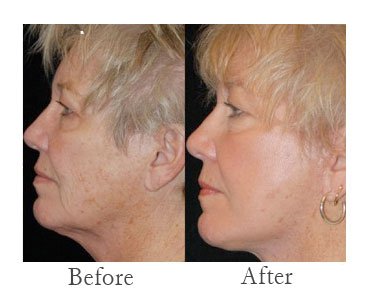 laser-skin-resurfacing.jpg