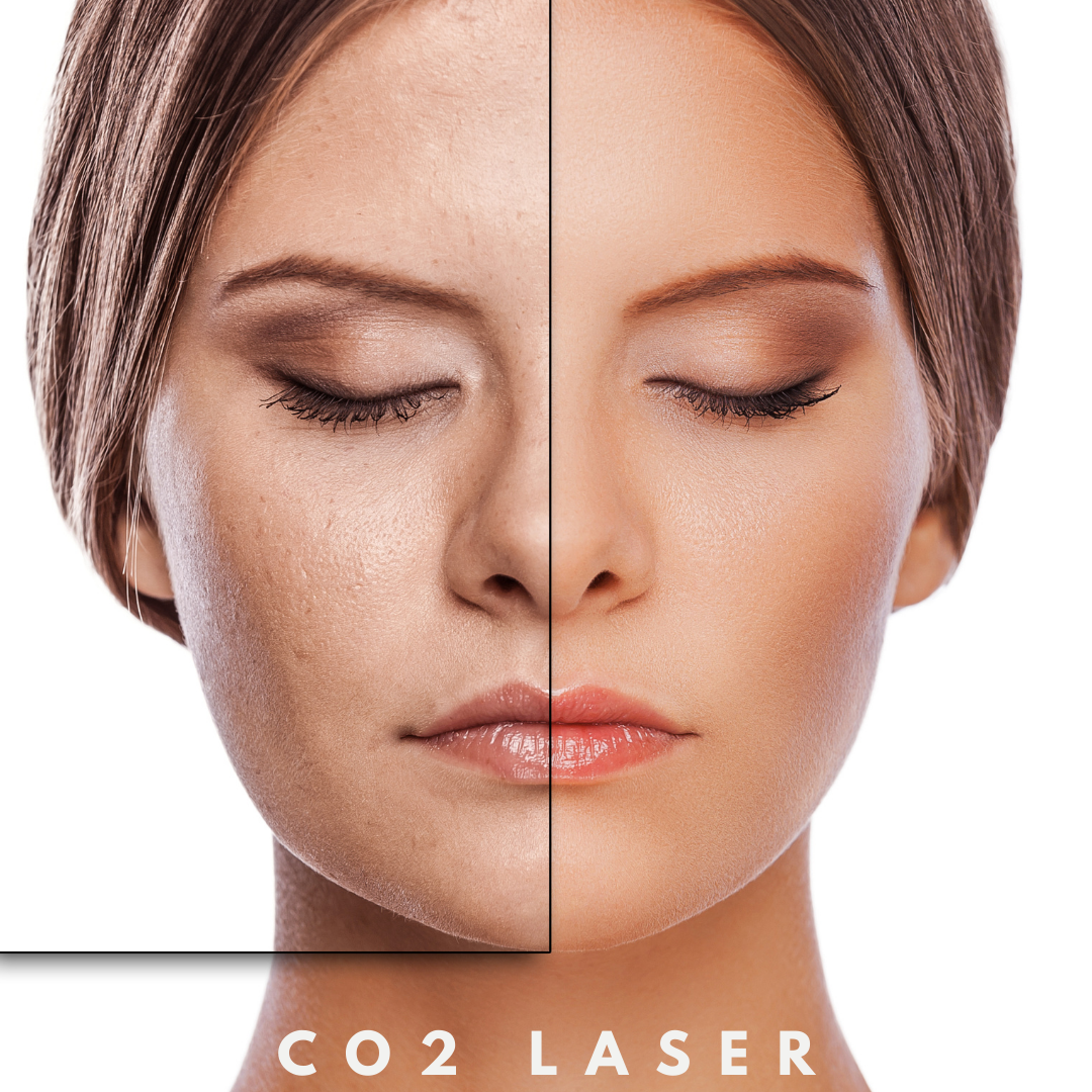 Co2 Laser Resurfacing