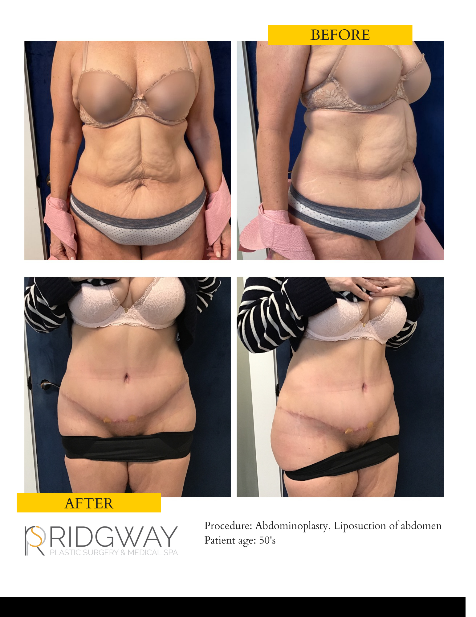 Adominoplasty (Tummy Tuck) & Liposuction - Case #02402 - The Plastic  Surgery Group