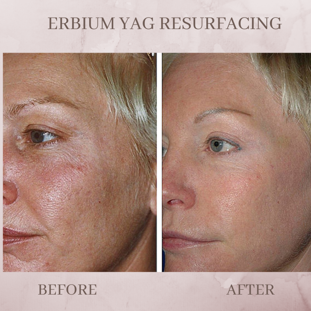 Erbium-Yag-resurfacing-before-and-after-1024x1024-30541366.png