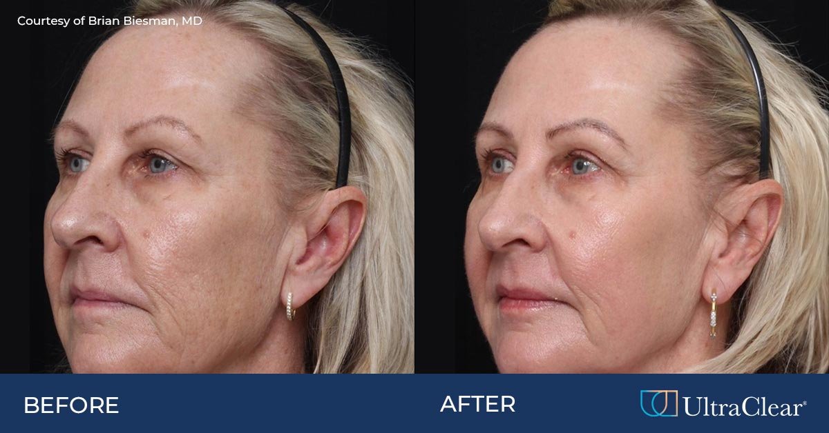 ultraclear-before-after-fb-1-4250770188.jpg
