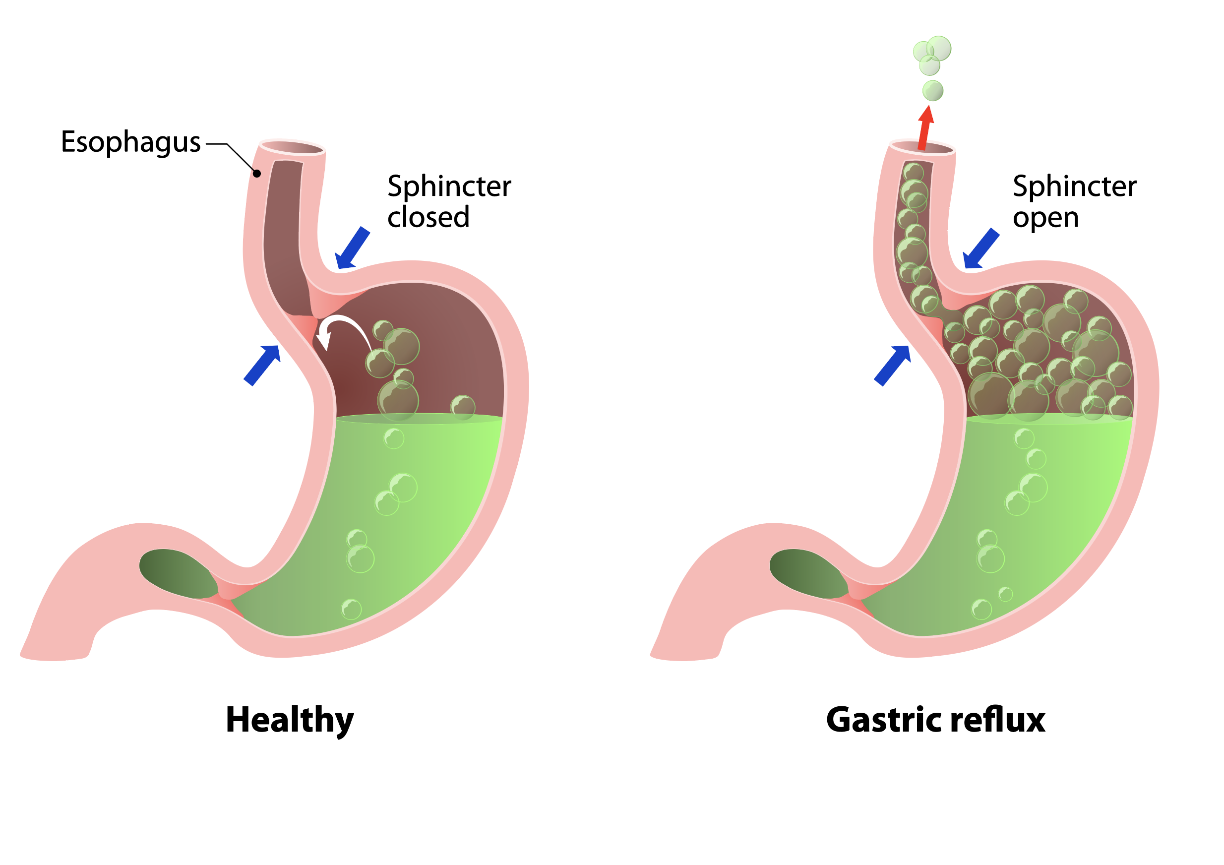 Stomach Acid Diagram Stomach Acid Diagram