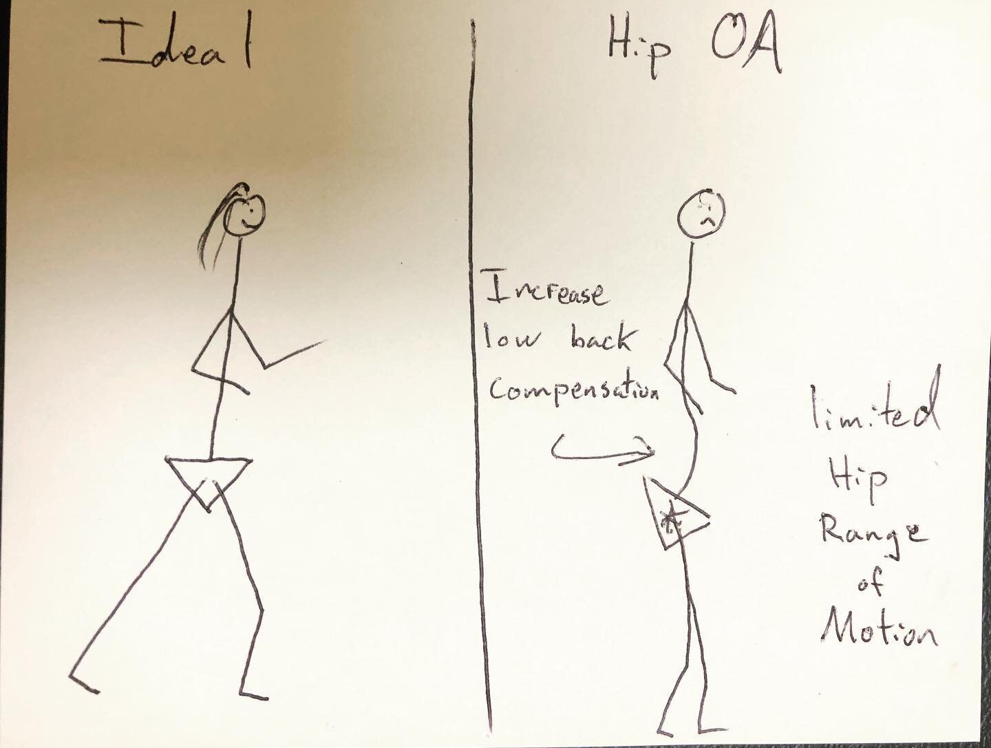 I get this question a lot from patients. &ldquo;Why could my back pain come from a hip problem?!?!&rdquo; 

Easy, allow my stick figure drawing to explain.

If your body cannot get the range of motion it needs from one joint, there&rsquo;s a good cha