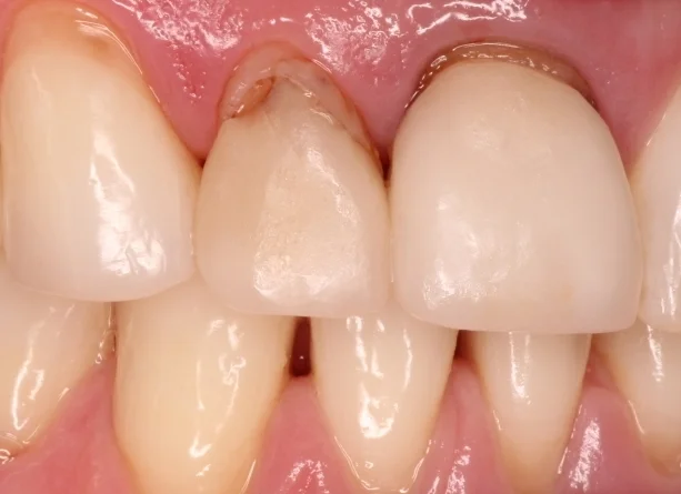 BEFORE This patient came to Family Holistic Dentistry because she didn't like the appearance of her veneer in her lateral incisor and needed to start a new job. She couldn't neither afford nor wait for a new veneer. BioClear was a great option for her, we removed the old veneer and did a BioClear restoration for her with a BPA and fluoride free composite.