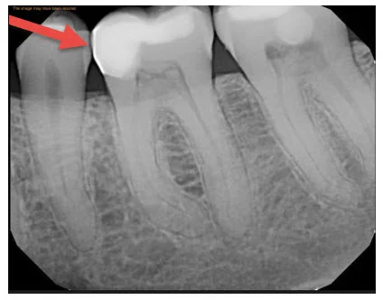 x-ray-after.jpg