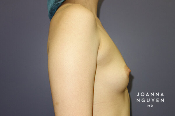Joanna_Nguyen_Before-After-Breast-Augmentation_1_F.jpg