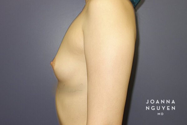 Joanna_Nguyen_Before-After-Breast-Augmentation_1_L.jpg