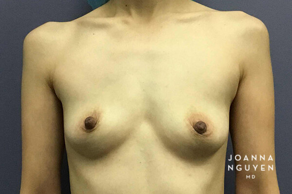Joanna_Nguyen_Before-After-Breast-Augmentation_2_A copy.jpg
