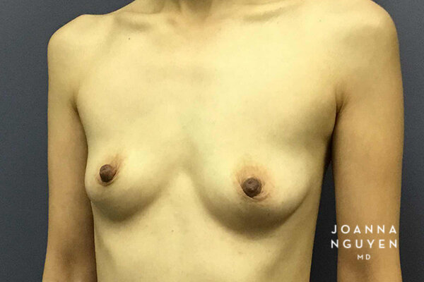 Joanna_Nguyen_Before-After-Breast-Augmentation_2_C.jpg