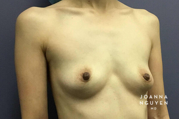 Joanna_Nguyen_Before-After-Breast-Augmentation_2_B.jpg