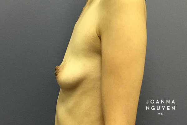 Joanna_Nguyen_Before-After-Breast-Augmentation_2_D.jpg