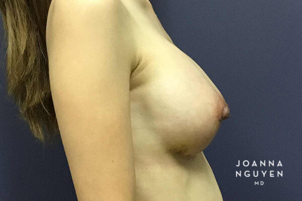 Joanna_Nguyen_Before-After-Breast-Augmentation_2_J.jpg