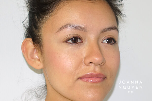 Joanna_Nguyen_Before-After-Otoplasty-B2.jpg