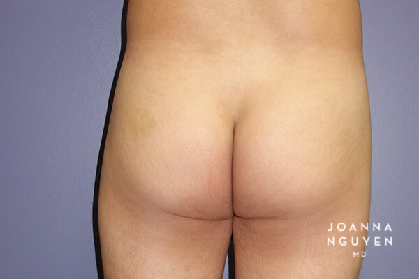 Joanna_Nguyen_Before-After-Gluteal-Implants-G2.jpg