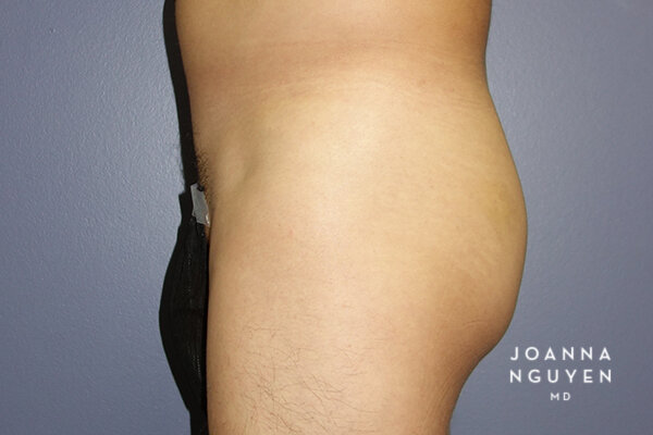 Joanna_Nguyen_Before-After-Gluteal-Implants-F2.jpg