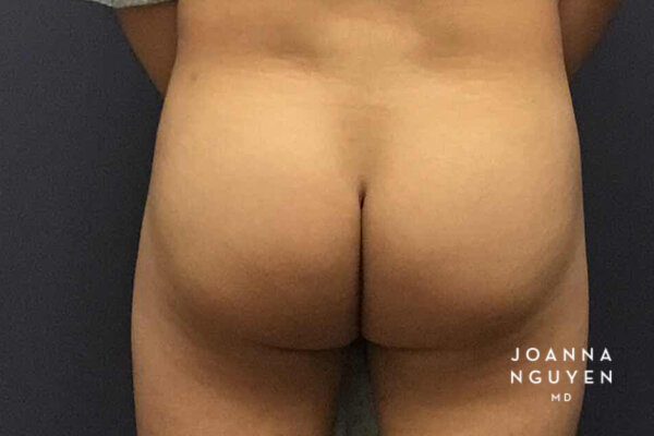 Joanna_Nguyen_Before-After-Gluteal-Implants-E2.jpg