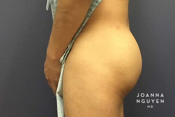 Joanna_Nguyen_Before-After-Gluteal-Implants-C2.jpg