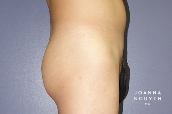 Joanna_Nguyen_Before-After-Gluteal-Implants-I2.jpg