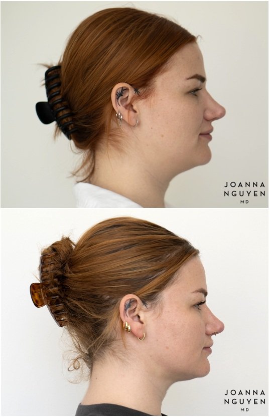 jnguyenmd.facialcontouring3.3.jpg