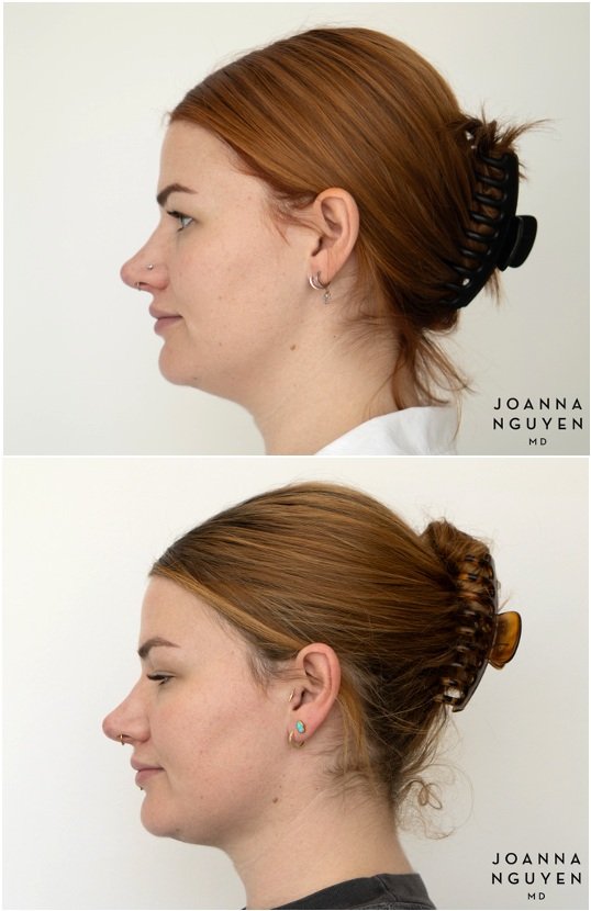 jnguyenmd.facialcontouring3.4.jpg