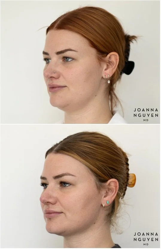 jnguyenmd.facialcontouring3.5.jpg