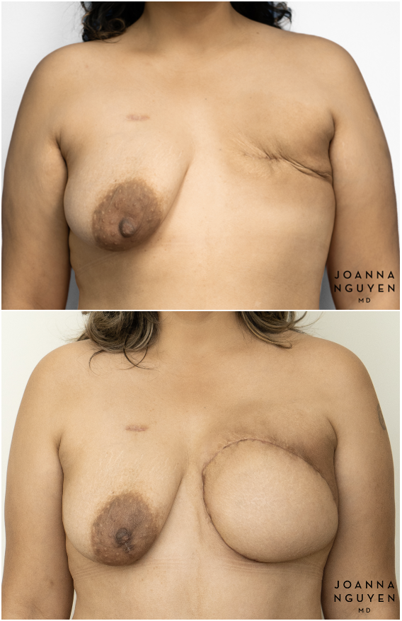 jnguyenmd.breastrecon2.1.png