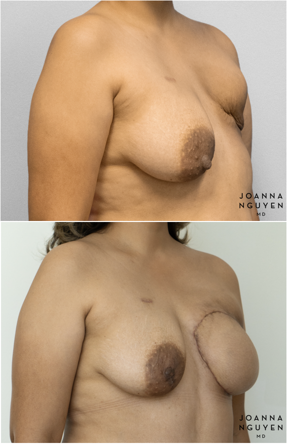 jnguyenmd.breastrecon2.2.png