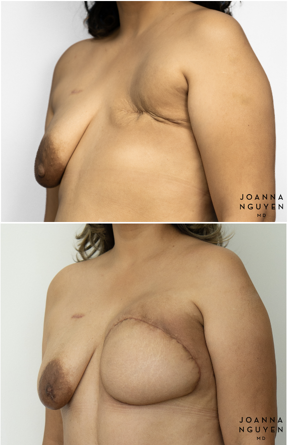 jnguyenmd.breastrecon2.3.png