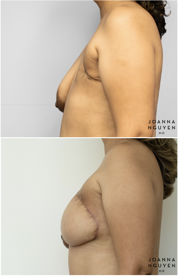 jnguyenmd.breastrecon2.4.png