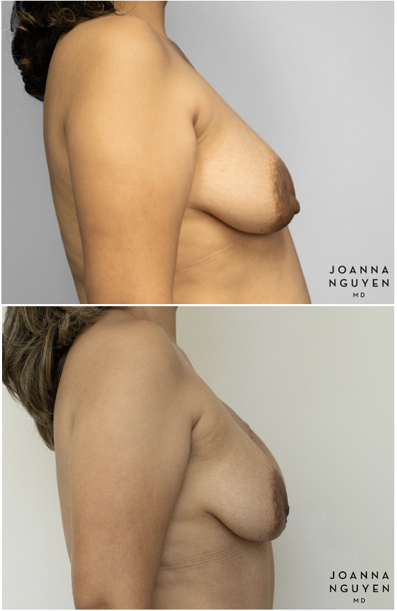 jnguyenmd.breastrecon2.5.png