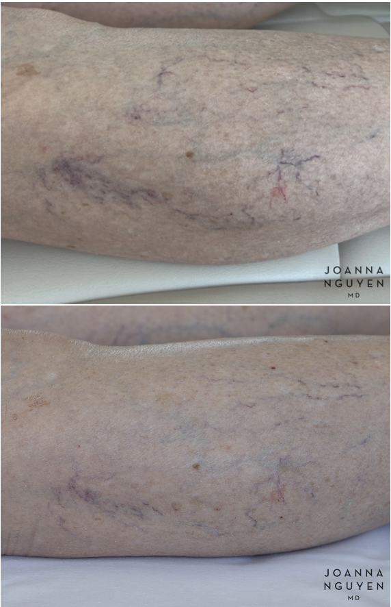 jnguyenmd.sclerotherapy2.1.png