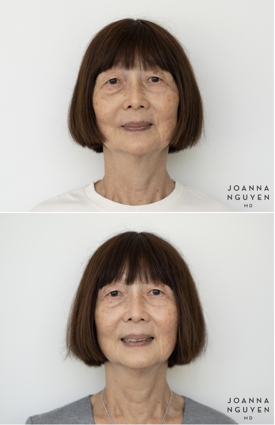 jnguyenmd.collagenstim1.1.png