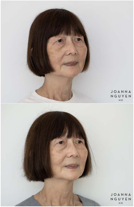 jnguyenmd.collagenstim1.2.png