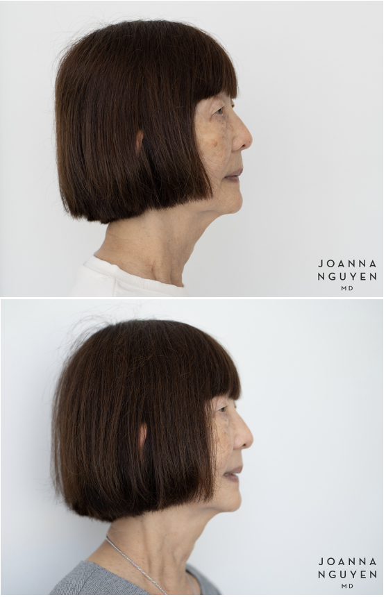 jnguyenmd.collagenstim1.4.png