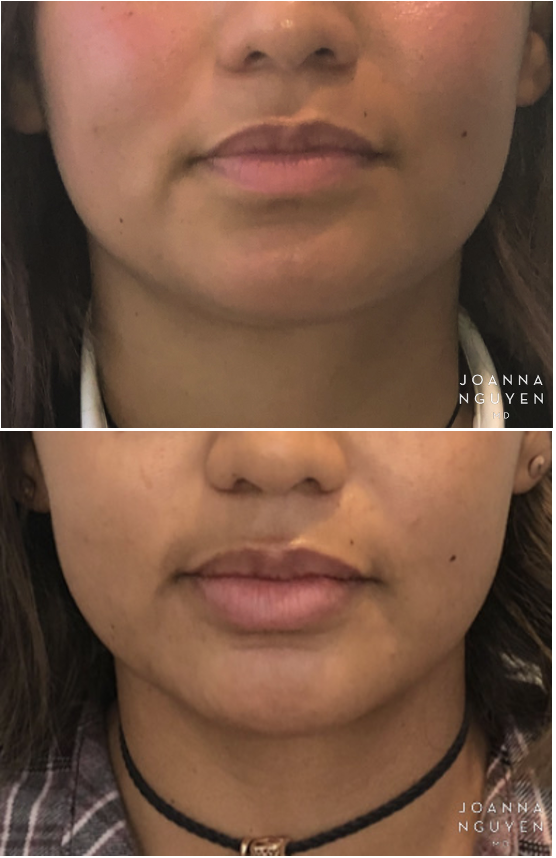 jnguyenmd.lipaugmentation6.1.png
