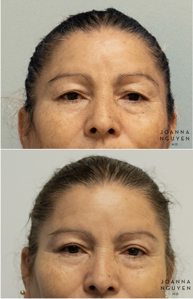 jnguyenmd.blepharoplasty3.1.png