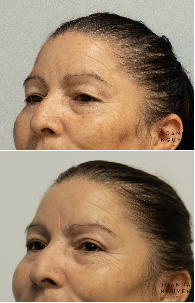jnguyenmd.blepharoplasty3.3.png