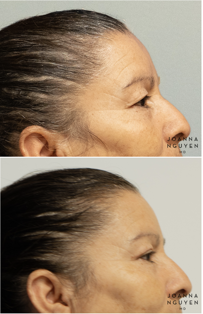 jnguyenmd.blepharoplasty3.4.png