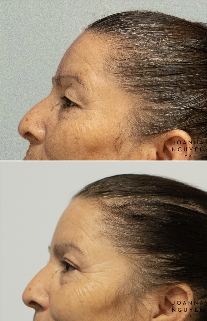 jnguyenmd.blepharoplasty3.5.png