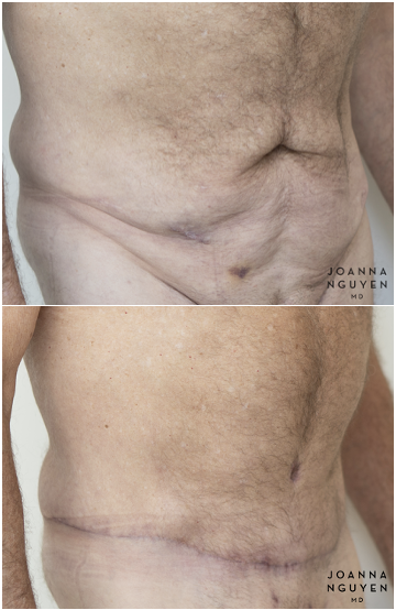 jnguyenmd.abdominoplasty3.2.png