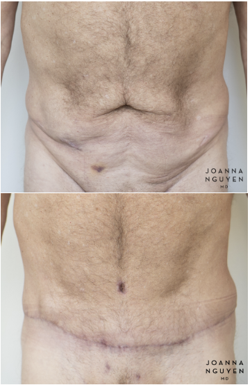 jnguyenmd.abdominoplasty3.1.png