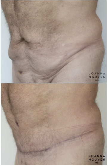 jnguyenmd.abdominoplasty3.3.png