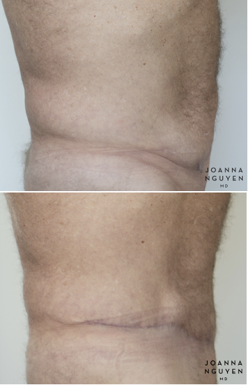 jnguyenmd.abdominoplasty3.4.png